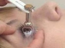 Тонометрия по Маклакову Тонометрия по Маклакову